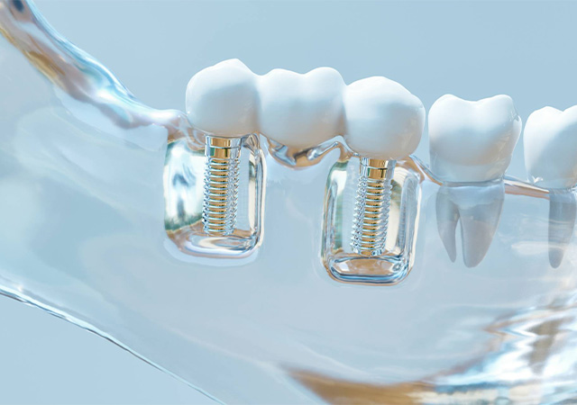 インプラント模型