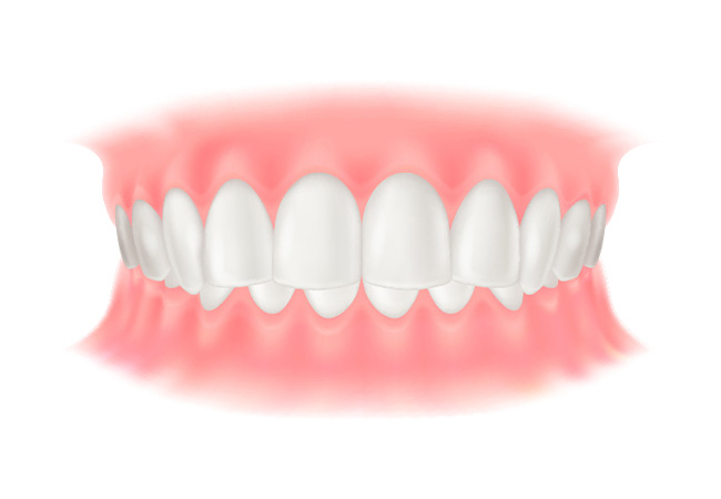 過蓋咬合（かがいこうごう）