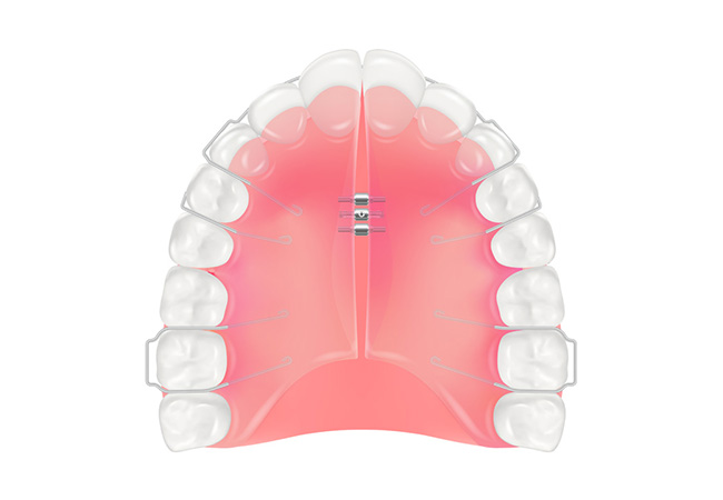 床拡大装置（床矯正装置）
